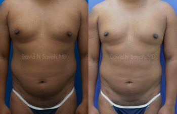 Liposuction Before and After | Sayah Institute