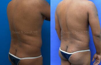 Liposuction Before and After | Sayah Institute