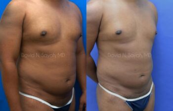 Liposuction Before and After | Sayah Institute