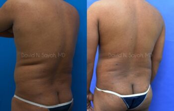 Liposuction Before and After | Sayah Institute