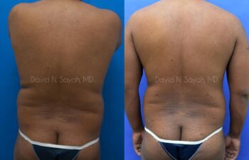 Liposuction Before and After | Sayah Institute