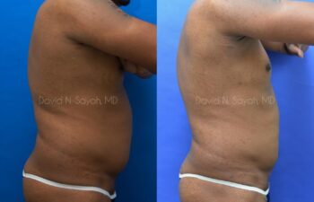 Liposuction Before and After | Sayah Institute