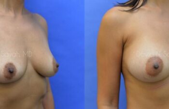 Breast Augmentation Before and After | Sayah Institute