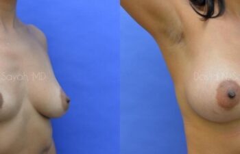 Breast Augmentation Before and After | Sayah Institute