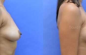 Breast Augmentation Before and After | Sayah Institute