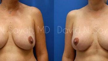 Breast Lift Before and After | Sayah Institute