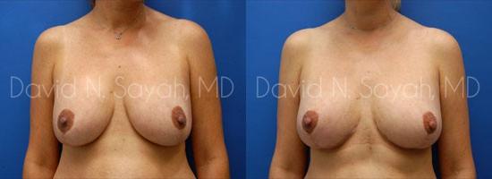 Breast Lift Before and After | Sayah Institute