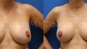 Breast Lift Before and After | Sayah Institute
