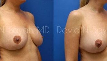 Breast Lift Before and After | Sayah Institute