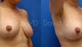Breast Lift Before and After | Sayah Institute