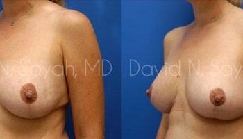 Breast Lift Before and After | Sayah Institute