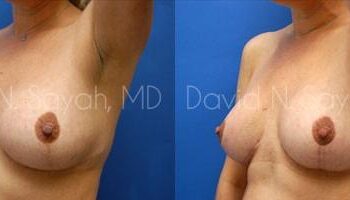 Breast Lift Before and After | Sayah Institute