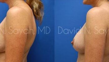 Breast Lift Before and After | Sayah Institute