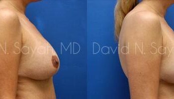 Breast Lift Before and After | Sayah Institute