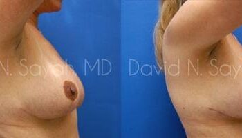 Breast Lift Before and After | Sayah Institute