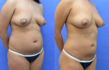 Fat Injection Breast Before and After | Sayah Institute