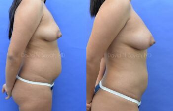 Fat Injection Breast Before and After | Sayah Institute