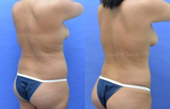 Fat Injection Breast Before and After | Sayah Institute