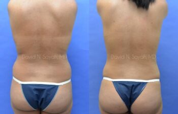Fat Injection Breast Before and After | Sayah Institute