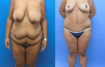 Breast Lift Before and After | Sayah Institute