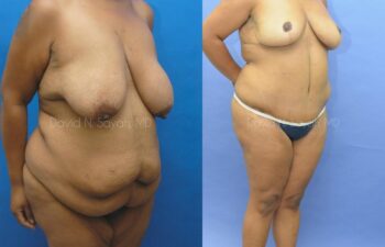 Breast Lift Before and After | Sayah Institute