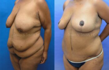 Breast Lift Before and After | Sayah Institute