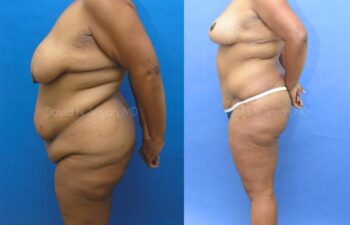 Breast Lift Before and After | Sayah Institute