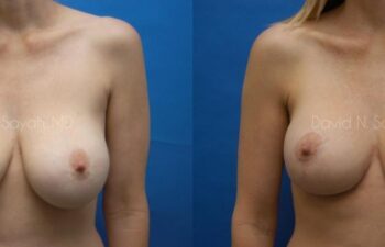 Breast Lift Before and After | Sayah Institute
