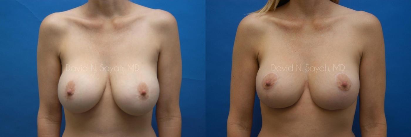 Breast Lift Before and After | Sayah Institute
