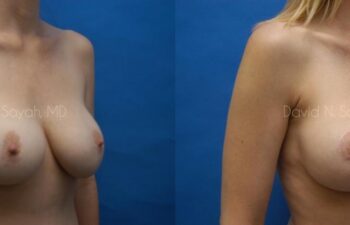 Breast Lift Before and After | Sayah Institute