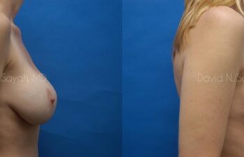 Breast Lift Before and After | Sayah Institute