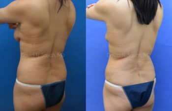Liposuction Before and After | Sayah Institute