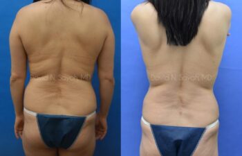 Liposuction Before and After | Sayah Institute