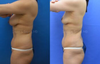 Liposuction Before and After | Sayah Institute