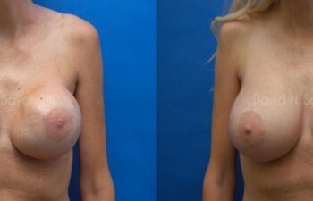 Breast Implant Exchange Before and After | Sayah Institute