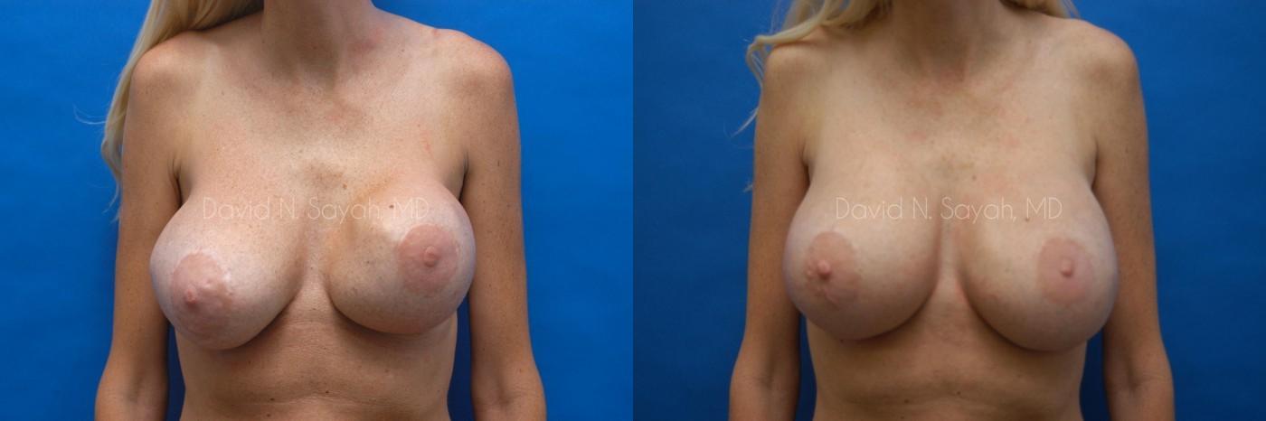 Breast Implant Exchange Before and After | Sayah Institute