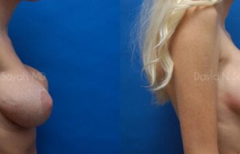 Breast Implant Exchange Before and After | Sayah Institute