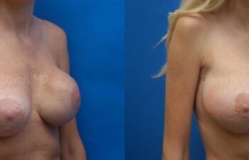 Breast Implant Exchange Before and After | Sayah Institute