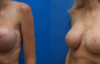 Breast Implant Exchange Before and After | Sayah Institute