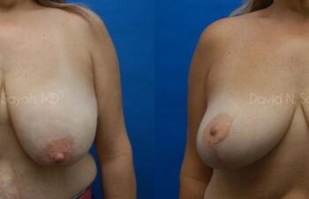 Breast Lift Before and After | Sayah Institute