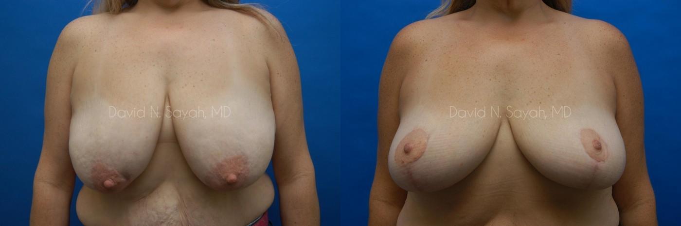 Breast Lift Before and After | Sayah Institute