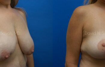 Breast Lift Before and After | Sayah Institute
