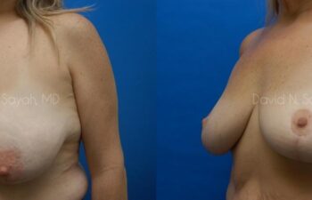 Breast Lift Before and After | Sayah Institute