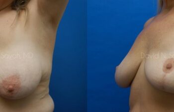 Breast Lift Before and After | Sayah Institute