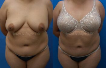 Liposuction Before and After | Sayah Institute