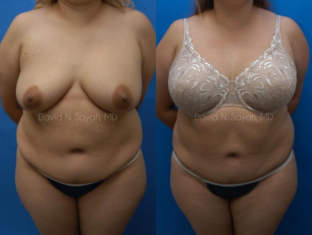 Liposuction Before and After | Sayah Institute