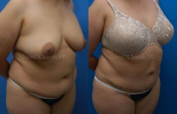 Liposuction Before and After | Sayah Institute