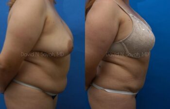 Liposuction Before and After | Sayah Institute