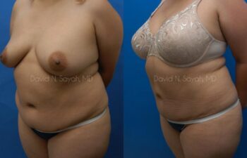 Liposuction Before and After | Sayah Institute