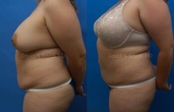 Liposuction Before and After | Sayah Institute